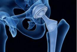 Hip Replacement – Procedures and Options